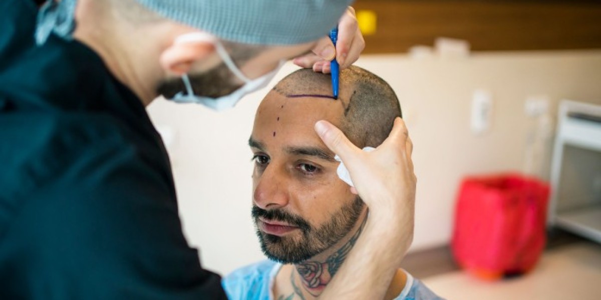 The Top 10 Hair Transplant Myths That Could Cost You