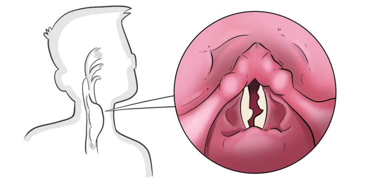 Vocal Cord Paralysis Treatment Market: Technology Trends and Forecasts