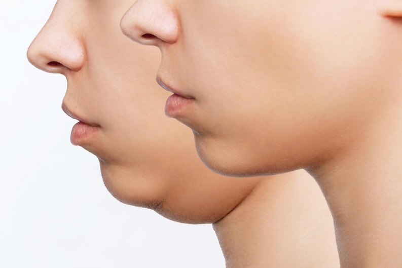 How Can I Get Rid of My Double Chin? - Mindful Guide