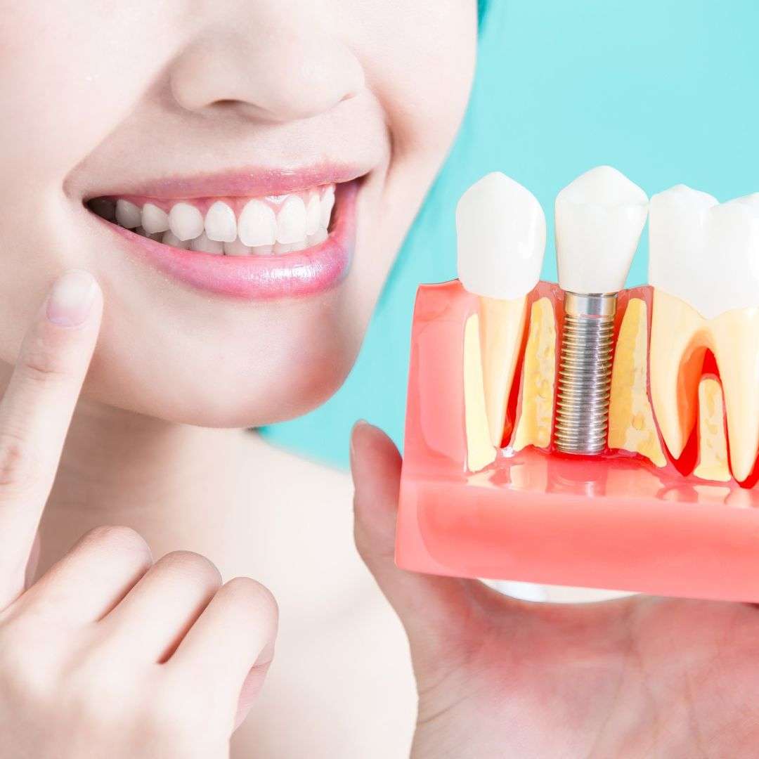 Dental Implant Profile Picture