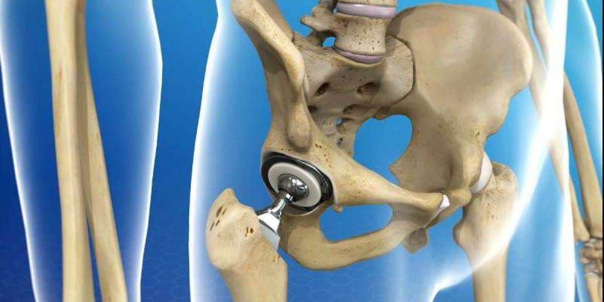 HIP Replacement Market Size, Trends and Competitive Analysis 2023-2029