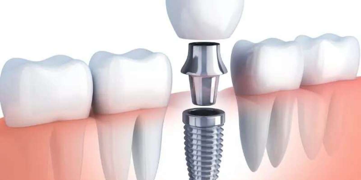 Understanding Tooth Replacement Costs in McKinney, TX: Navigating Your Options
