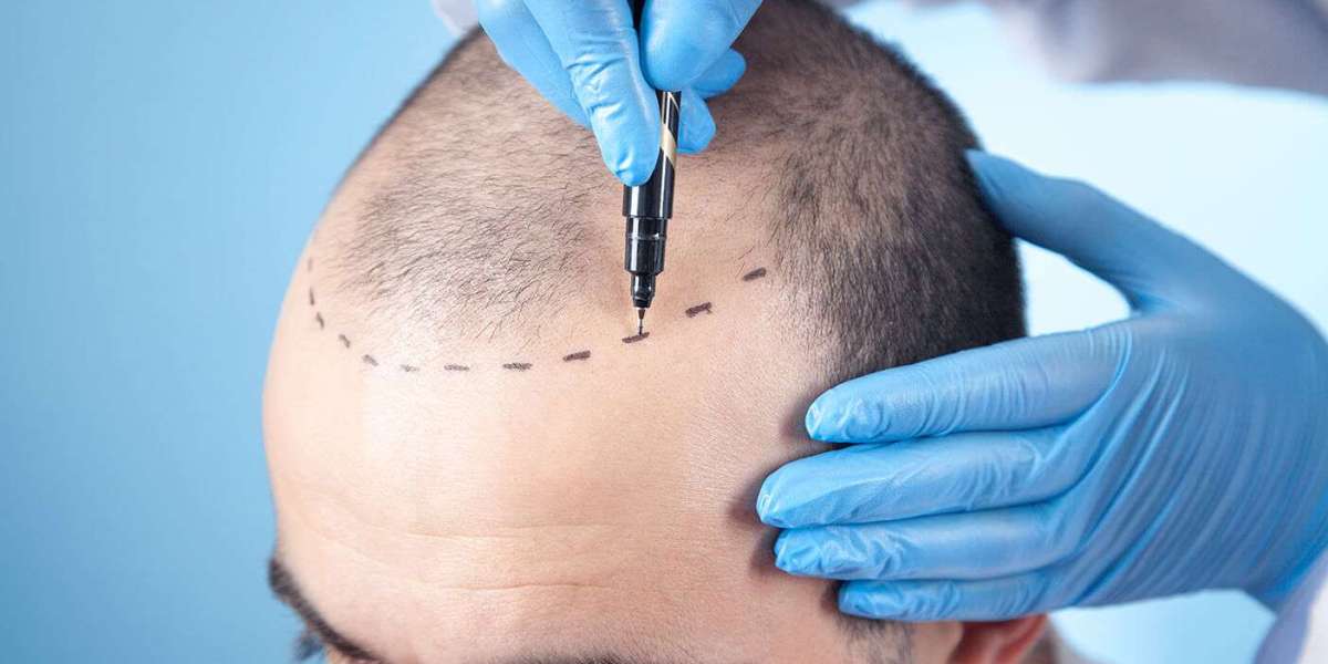 The Definitive Guide to Finding the Best Hair Transplant Clinic in Turkey