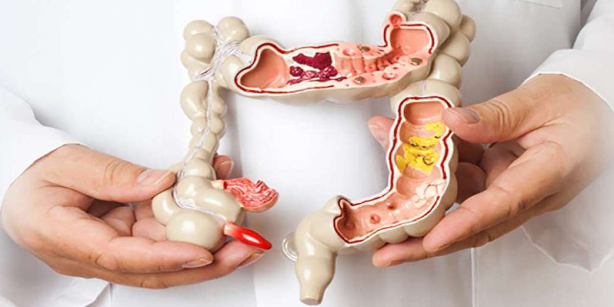 Consultant Colorectal Surgeon in Mumbai: Your Key to Digestive Health