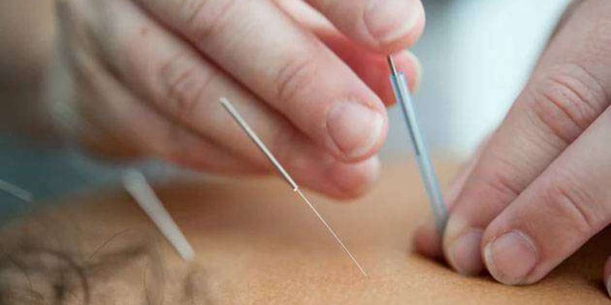 Dry Needling Physiotherapy in Surrey, BC