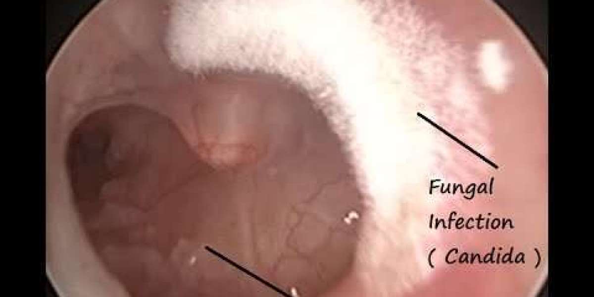 Understanding and Treating Fungal Ear Infections: A Comprehensive Guide